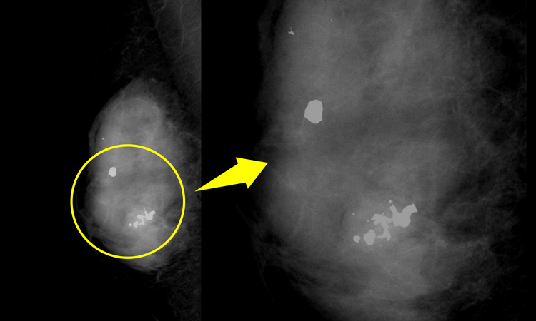 乳房 の 石灰 化