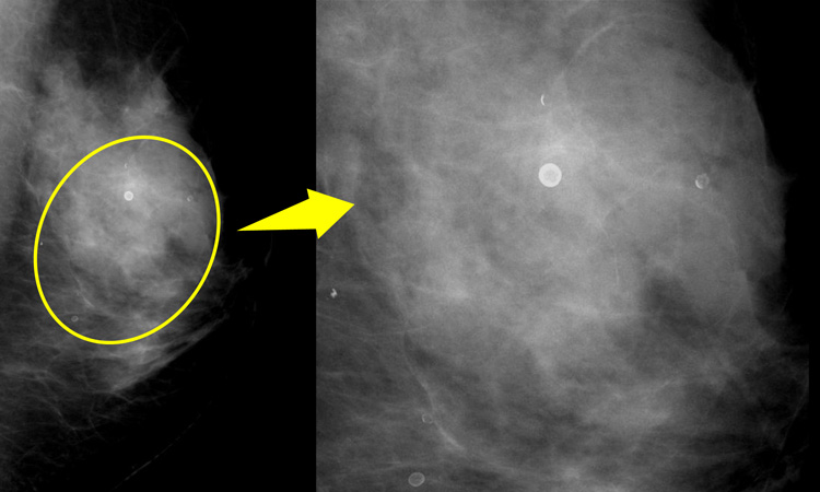乳房 の 石灰 化