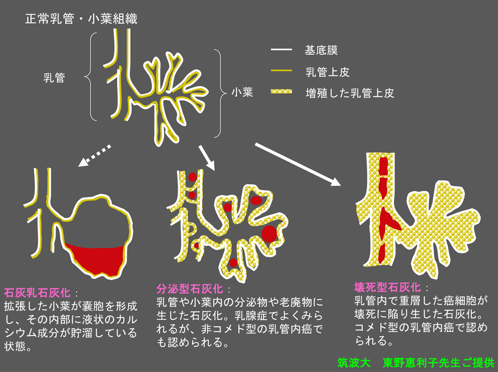 乳がん